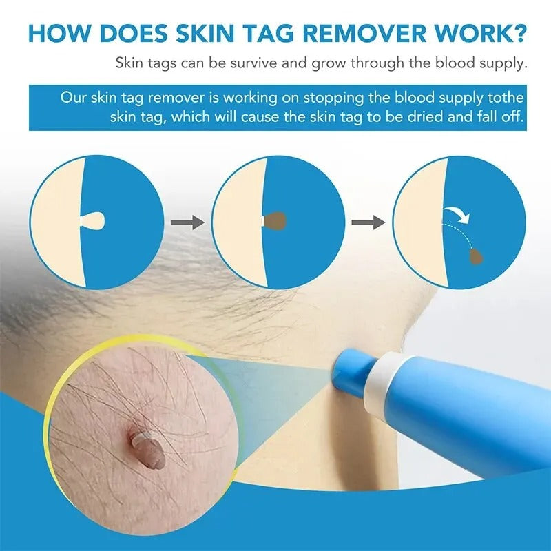 Velvaro Skin Tag Removal Kit