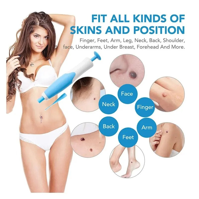 Velvaro Skin Tag Removal Kit