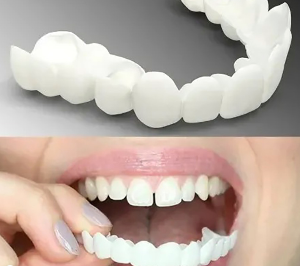 Velvaro Adjustable Snap-On Dentures