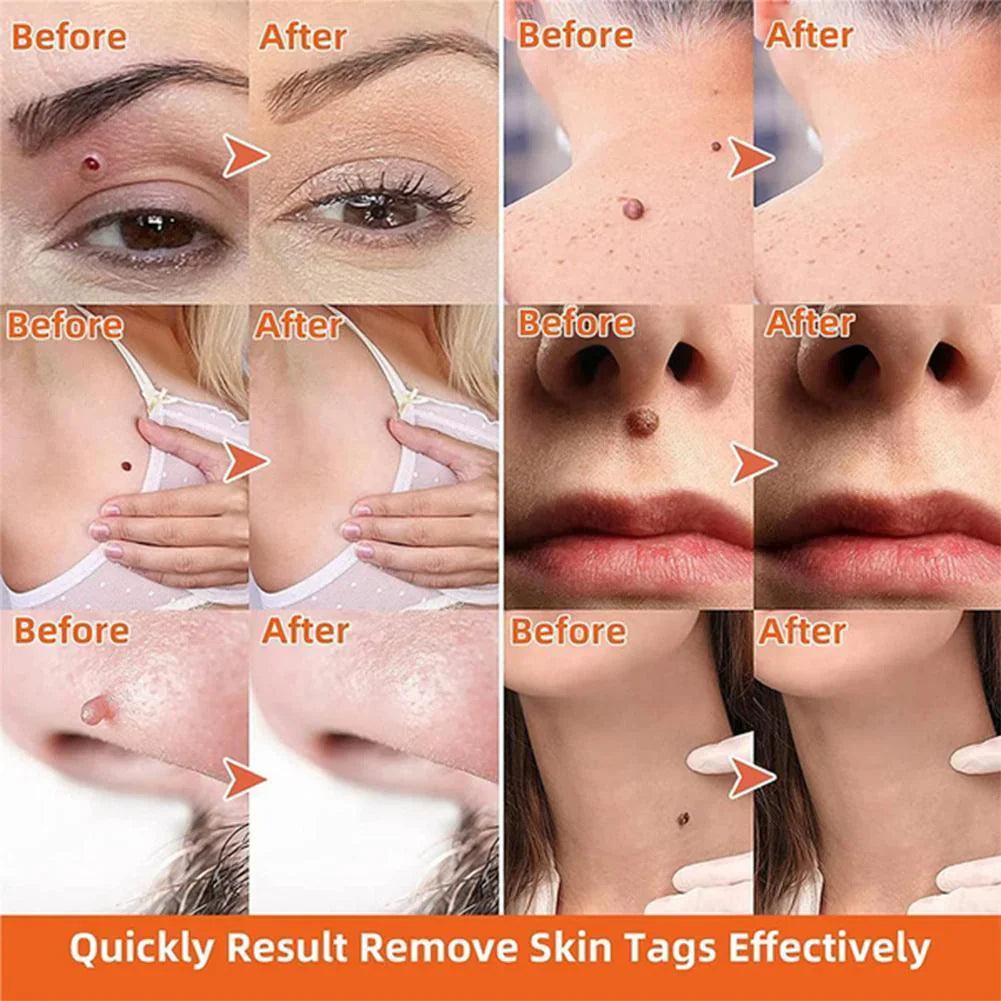 Velvaro Auto Skin Tag Remover Pen