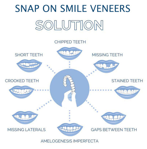 Velvaro Snap-On Smile Veneers