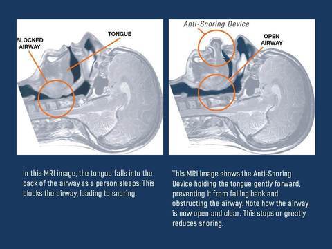 Velvaro Apnea Tongue Stabilizing Device